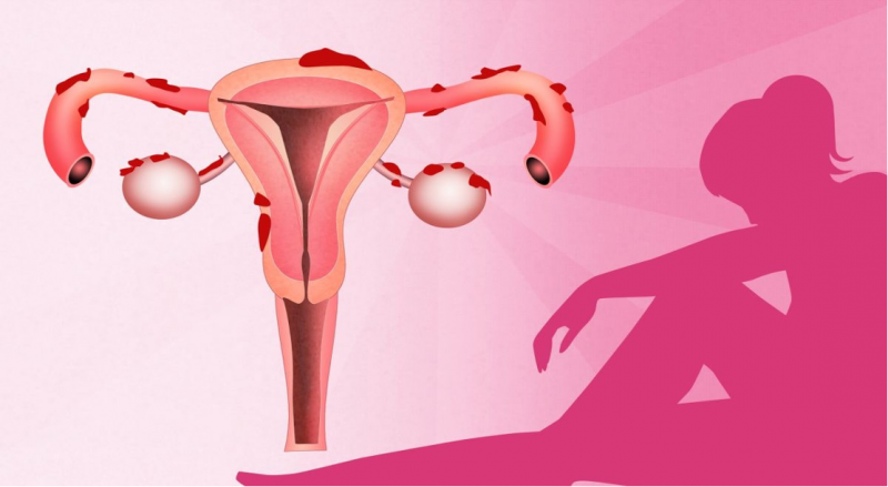 pitanie_pri_endometrioze.png